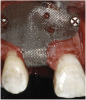 Figure 5  Titanium mesh/particulate graft complex.