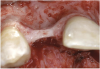 Figure 6  Facial and palatal alveolar ridge width deficiency.
