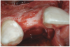 Figure 7  Post-augmentation alveolar ridge width net gain of 7 mm (7 months).