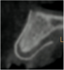 Figure 8  Post-augmentation CBCT sagittal view (7 months).
