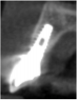 Figure 10  Two-year post completion, CBCT sagittal view.