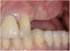 Figure 11  Edentulous left posterior maxilla with alveolar ridge deficiency.