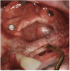 Figure 12  Preparation of left sinus augmentation and alveolar ridge split.