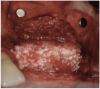 Figure 13  Completed left sinus graft/ridge split with interpositional bone graft (rhBMP-2/ACS plus mineralized allograft).