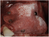 Figure 14  High-density porous polyethylene mesh with fixation.