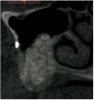 Figure 15  Seven months post-graft CBCT.