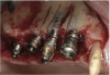 Figure 19  Failing implants in the right posterior maxilla.