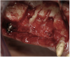 Figure 20  Removal of the failing implants.