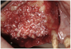 Figure 21  Bone grafting with rhPDGF, allograft, and xenograft.