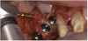 Figure 23  Trephinated core biopsy obtained at 5 months.