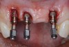 (13.) Reverse torqueing allows for a nonsurgical implant removal. No bone was sacrificed in removing these three implants.