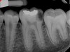 Fig 6. Preoperative radiograph of carious exposure on tooth No. 19. Courtesy of Dr. Mohammed A. Alharbi.
