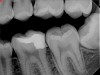 Fig 9. Immediate postoperative radiograph. Courtesy of Dr. Mohammed A. Alharbi.