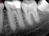 Fig 10. Radiograph taken at 6-month follow-up visit. Courtesy of Dr. Mohammed A. Alharbi.