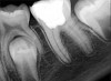 Fig 12. Postoperative radiography after full pulpotomy was performed. Courtesy of Dr. Guillaume Jouanny.