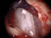 Fig 16. Post apicoectomy. Courtesy of Dr. Sam Kratchman.