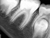 Fig 14. Contralateral tooth at 1-year follow-up. Courtesy of Dr. Guillaume Jouanny.