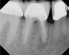 Fig 15. Preoperative radiograph. Courtesy of Dr. Sam Kratchman.