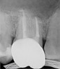 Fig 21. 5-year follow-up with complete healing. Courtesy of Dr. Allen Ali Nasseh.