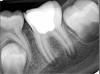 Fig 13. Tooth was asymptomatic at 1-year follow-up. Courtesy of Dr. Guillaume Jouanny.