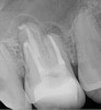 Fig 20. Immediate postoperative radiograph. Courtesy of Dr. Allen Ali Nasseh.