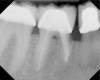 Fig 18. 20-month follow-up with BC putty shows complete healing. Courtesy of Dr. Sam Kratchman.