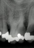 Fig. 1 Periapical radiograph of maxillary left first molar. Two-dimensional images lead to two-dimensional thinking.