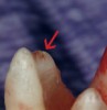 Fig. 4 High-magnification apical view of Figure 1 shows correct apical anatomy. Note the large palatal foramen is at least 1 mm short of the radiographic apex (arrow).