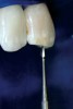 Fig. 16 The first access cut should occur at the palatal of the incisal edge, where a small channel is cut.