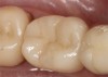 (2.) A CAD/CAM crown restoration with the addition of anatomic accentuation.