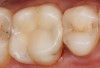 (6.) A two-surface inlay on an upper first molar.