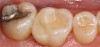 (7.) An onlay on an upper first molar.