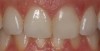 (16). Two cases in which tooth No. 9 was restored.