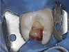 Fig. 2 Definitive isolation with a rubber dam is enhanced and areas of crevicular fluid leakage are properly sealed with the aid of a caulking material.