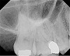 Fig 4. This maxillary first molar was to have endodontic therapy following diagnosis of irreversible pulpitis.