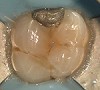 Fig. 5 This maxillary first molar was to have endodontic therapy following diagnosis of irreversible pulpitis.