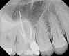 Fig. 12 The original ultra-conservative access may have saved some tooth structure, but would have resulted in missing the MB2, which would have negatively affected the case outcome postoperatively due to its separate apical exit.