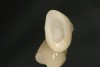 (4.) Single maxillary lithium disilicate crown.