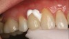 (5.) Crown placed using bioceramic cement (buccal and occlusal views).