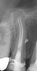 Figure 4. AND Figure 5. Before and after radiographs of bioceramic sealer hydraulically moved with the gutta-percha point. Note that the cold hydraulic technique results in lateral canal “puffs” similar to the warm vertical technique. Courtesy of Dr. Mohammed A. Alharbi.