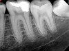 Figure 10. Radiograph taken at 6-month follow-up visit. Courtesy of Dr. Mohammed A. Alharbi.