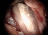 Figure 17. Retropreps and isthus filled. Courtesy of Dr. Sam Kratchman.