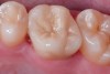 Fig 11. Preoperative view (Fig 9), preparation with composite block-out restoration (Fig 10), and final cementation of CL-IIb material (Fig 11) (final ceramic contour and stain by Steve Lee, CDT, MDC).