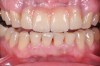 Fig 14. Porcelain-layered zirconia framework (CL-IIIb) with layered pink porcelain for the gingiva (Fig 13); final image in the mouth of the porcelain-layered zirconia framework (Fig 14) (images courtesy of Aram Torosian, MDC).