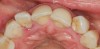 (1.) Pretreatment occlusal view showing crowding and inflamed palatogingival groove of tooth No. 7.