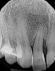 (2.) Pretreatment radiograph of tooth No. 7 showing widened periodontal ligament, dens in dente, dilacerations, and angular bone loss.