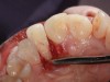 (4.) Surgical view of tooth No. 7 following odontoplasty.