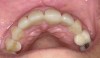 (6.) A 3-year, posttreatment photograph showing healthy tissue supporting the maxillary anterior teeth and correction of crowding.