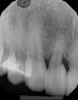 (7.) A 3-year, posttreatment radiograph showing a significant improvement in the angular bone loss on the mesial aspect of tooth No. 7.