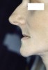 Figure 3. Same patient with dentures, illustrating how proper vertical dimension increases esthetics.